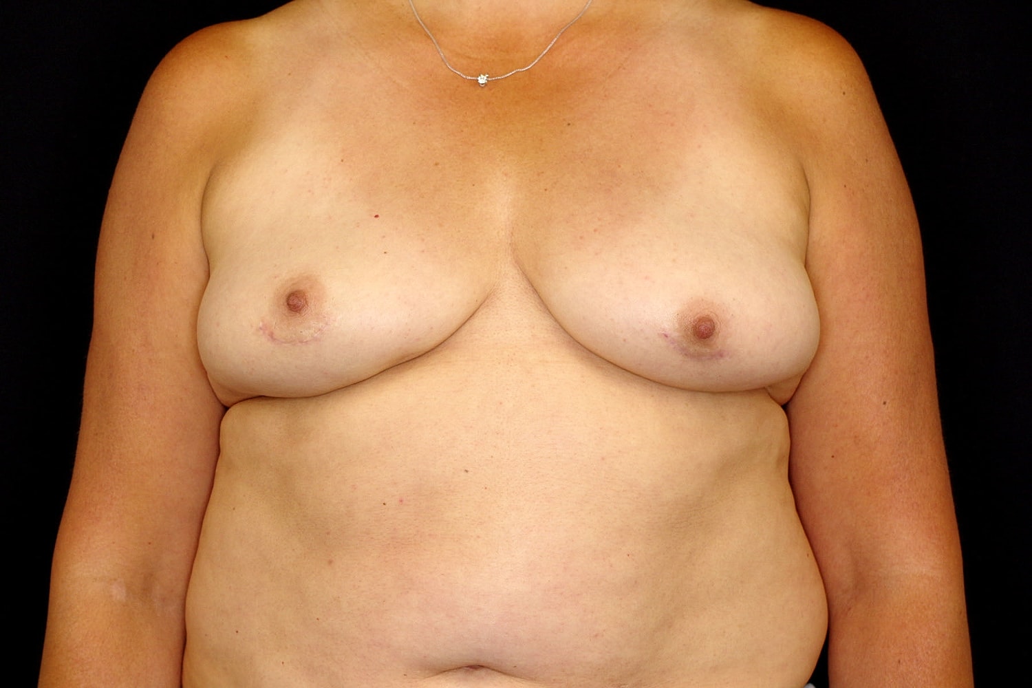 Breast Implant Removal Before & After