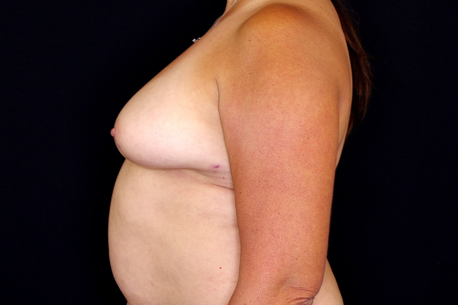 Breast Implant Removal Before & After