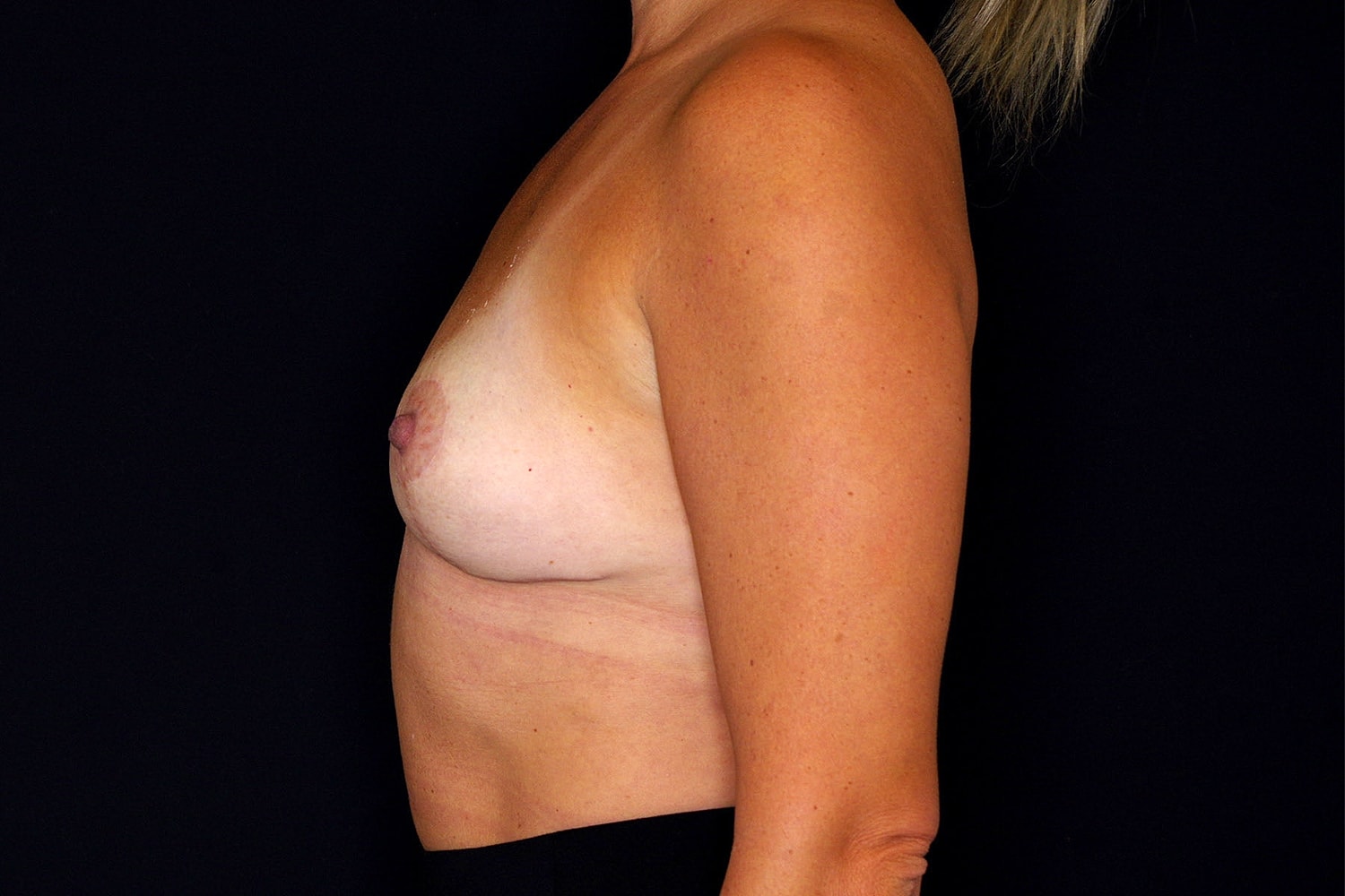 Breast Implant Removal Before & After