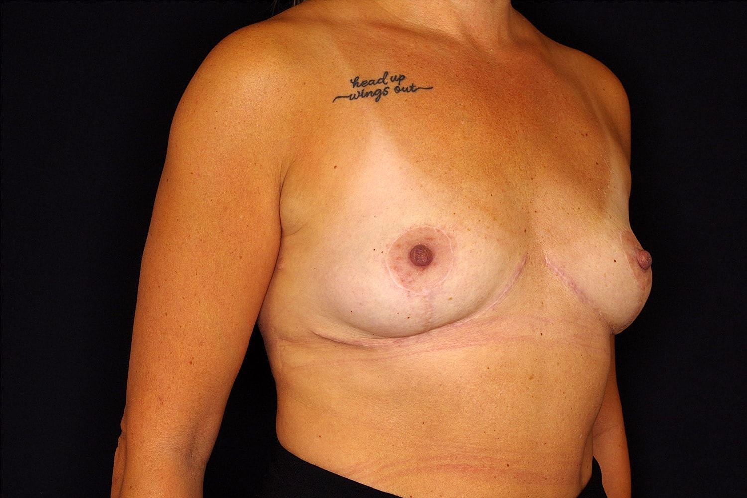Breast Implant Removal Before & After
