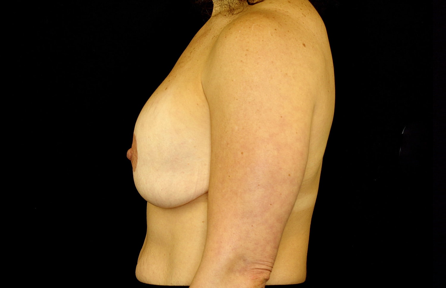 Breast Implant Removal Before & After