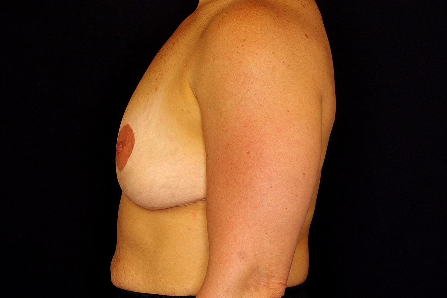 Breast Implant Removal Before & After