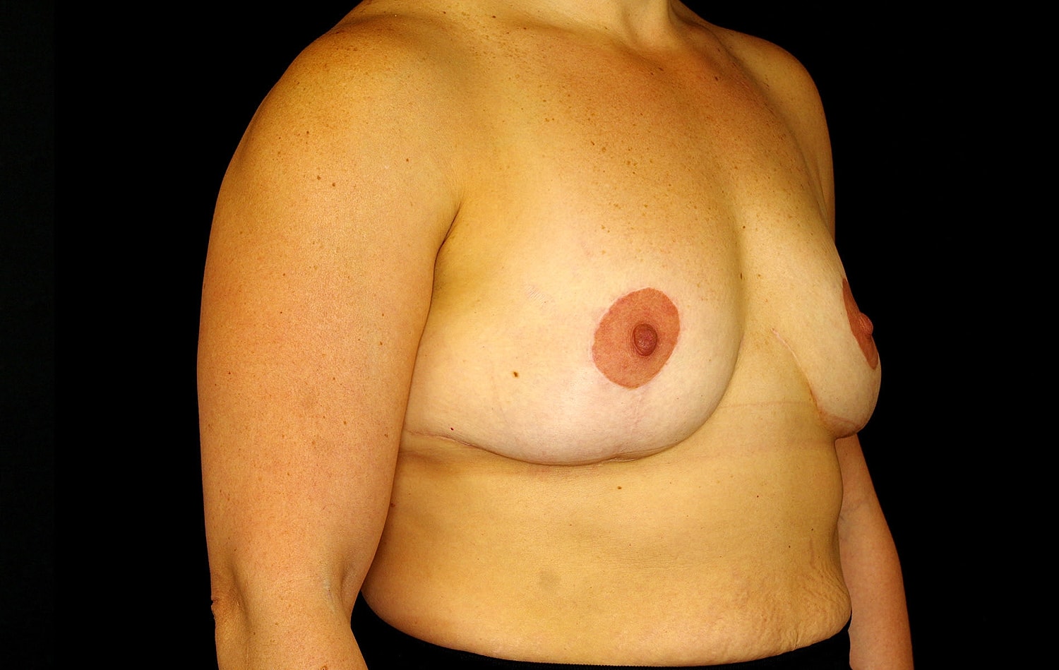 Breast Implant Removal Before & After