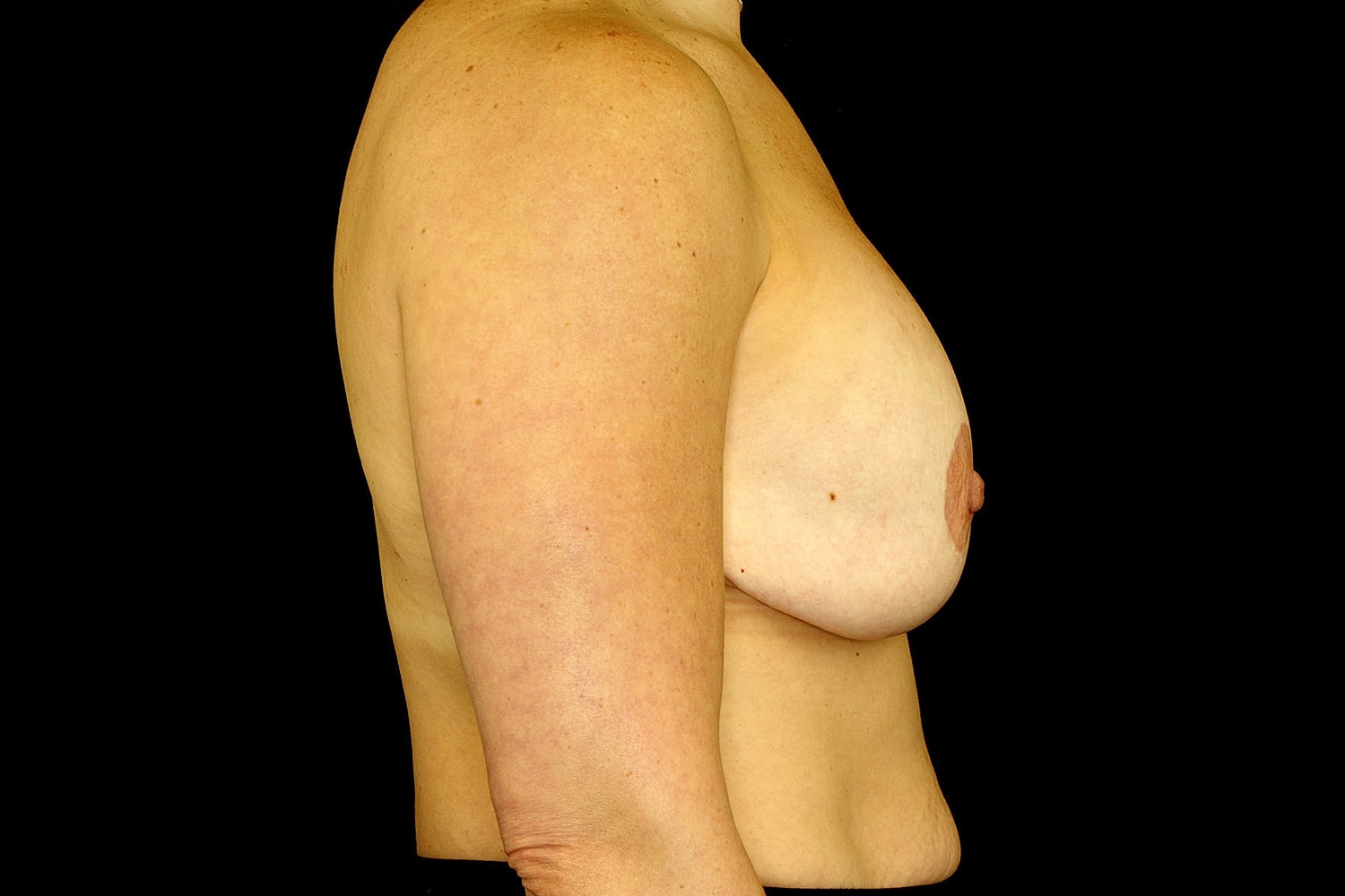 Breast Implant Removal Before & After