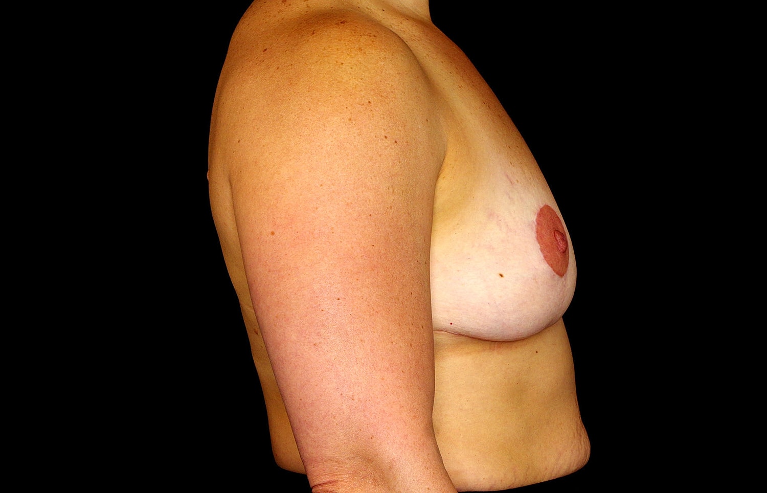 Breast Implant Removal Before & After