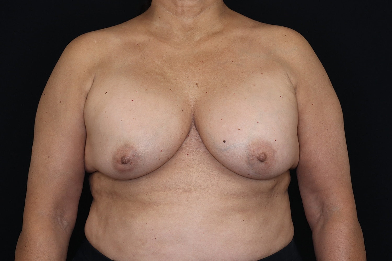 Breast Implant Removal Before & After