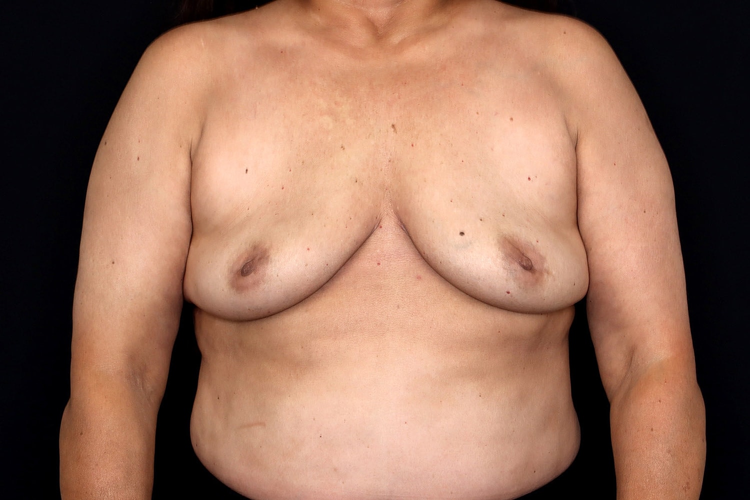 Breast Implant Removal Before & After