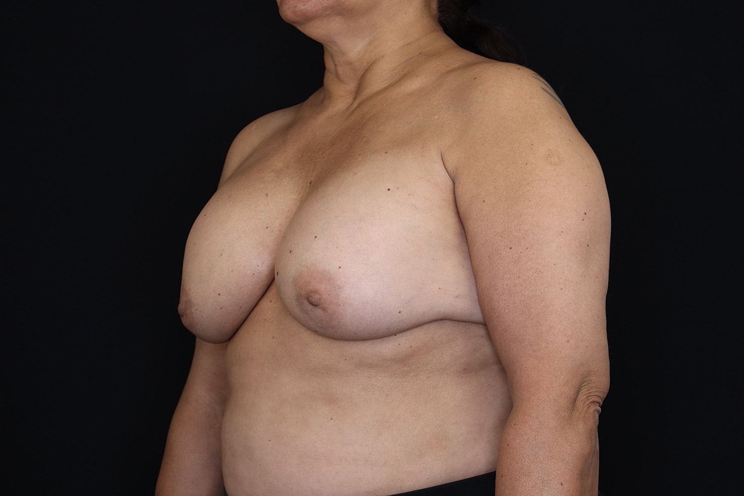 Breast Implant Removal Before & After