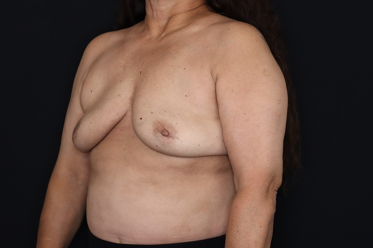Breast Implant Removal Before & After