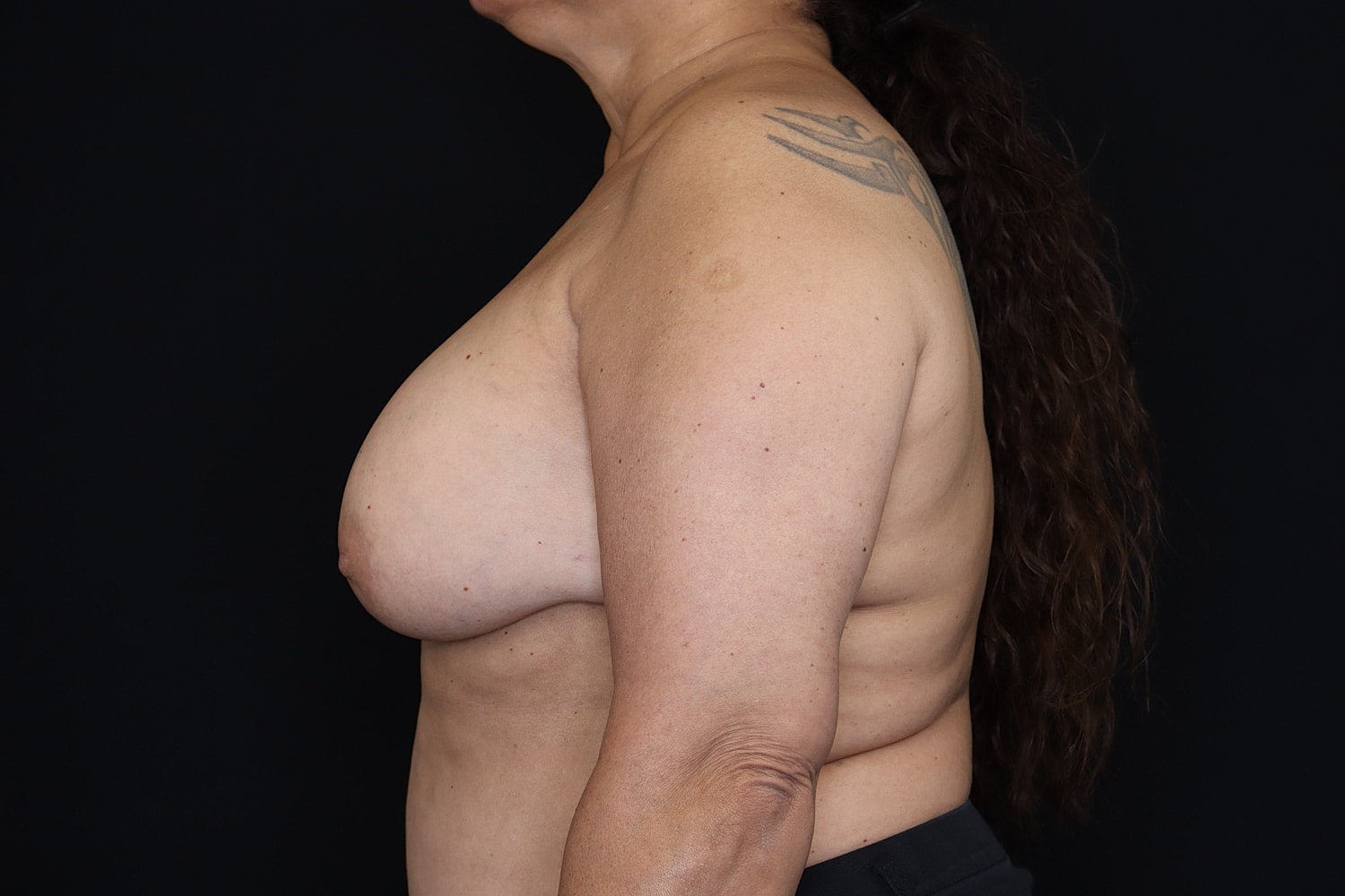 Breast Implant Removal Before & After