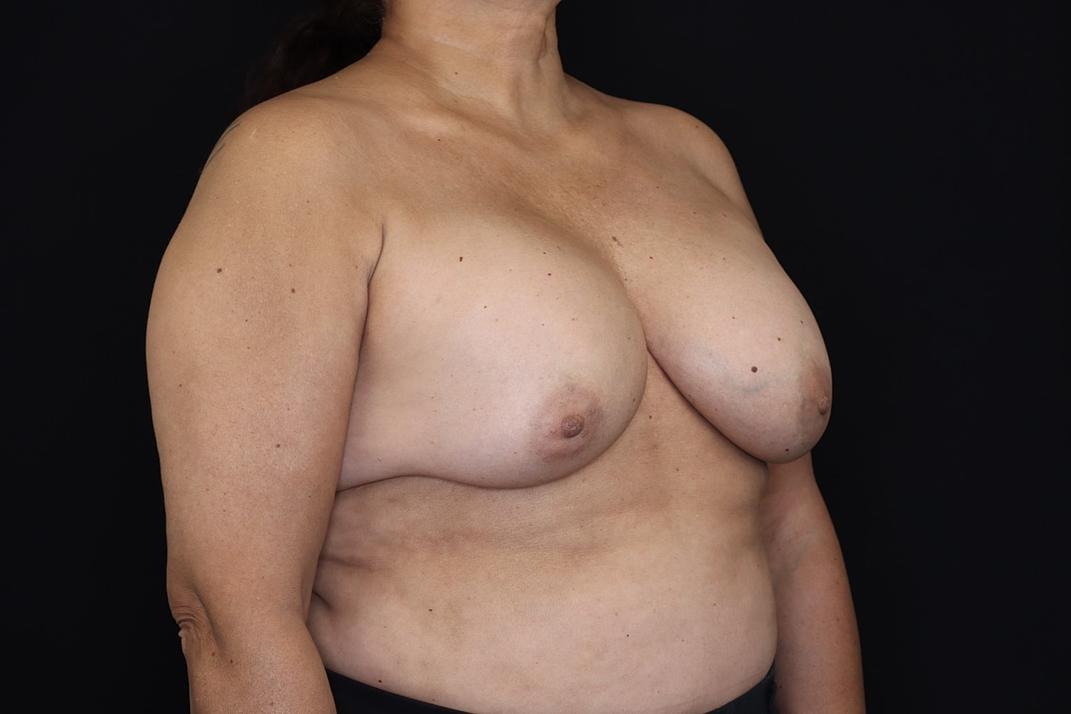 Breast Implant Removal Before & After