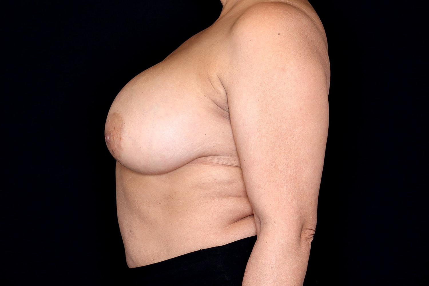 Breast Implant Removal Before & After
