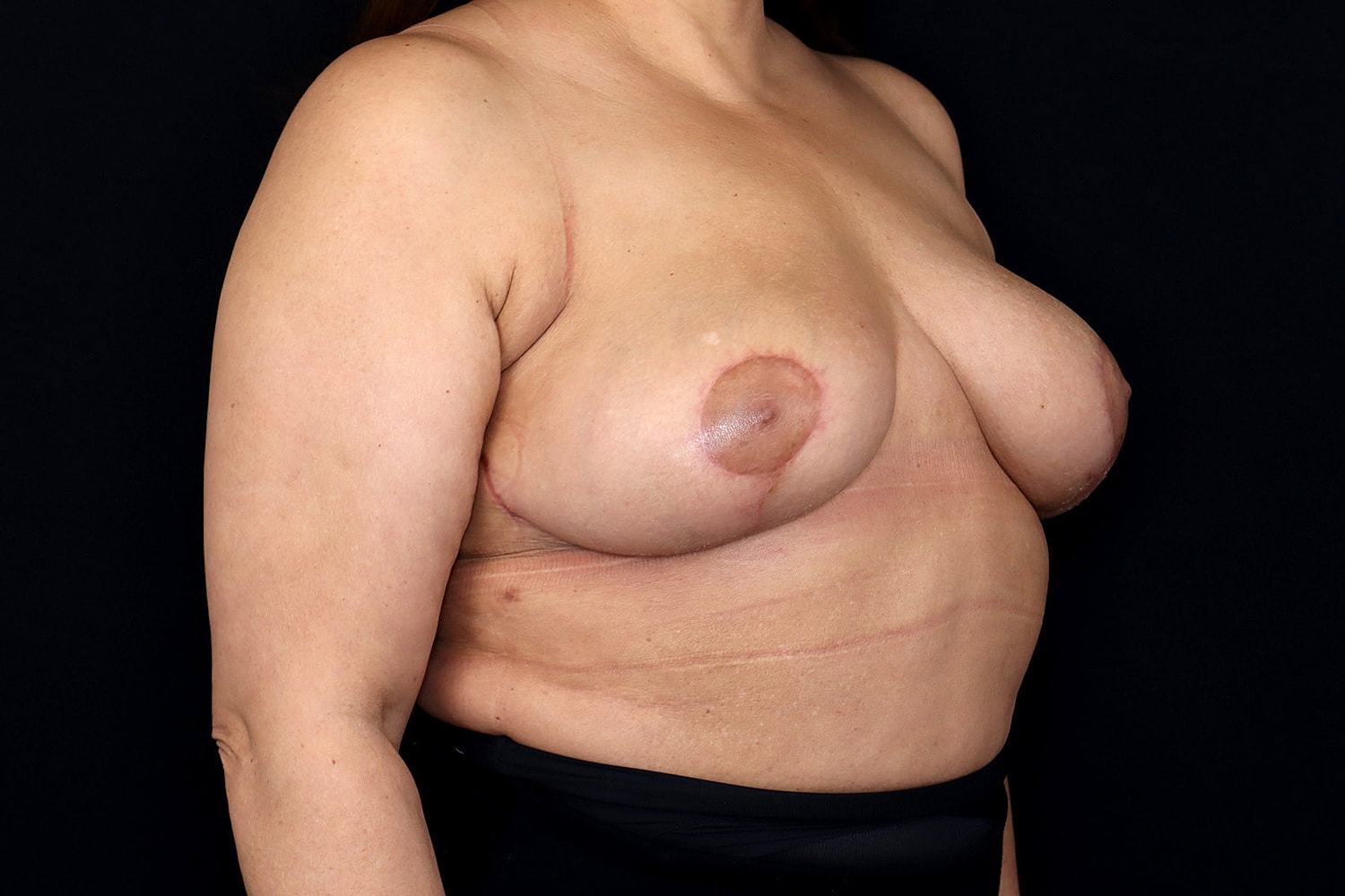 Breast Implant Removal Before & After