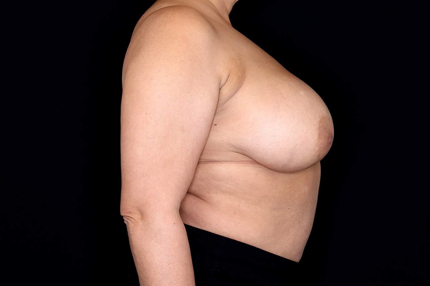 Breast Implant Removal Before & After