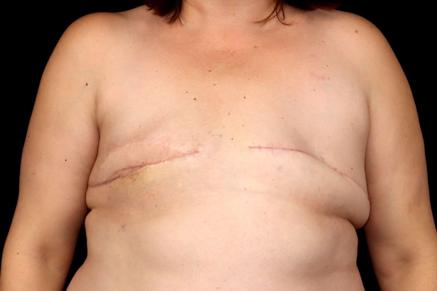 Breast Implant Removal Before & After