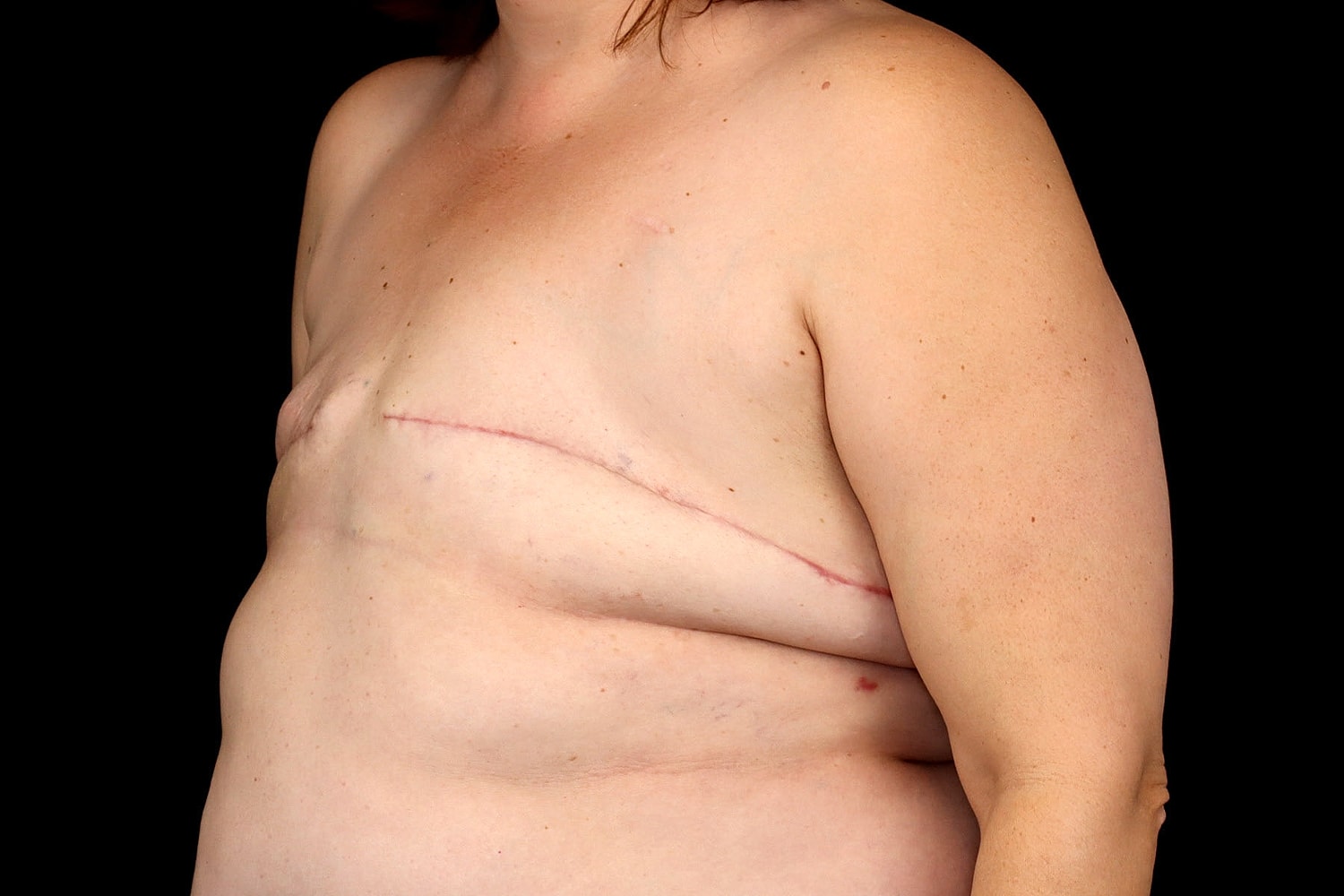 Breast Implant Removal Before & After