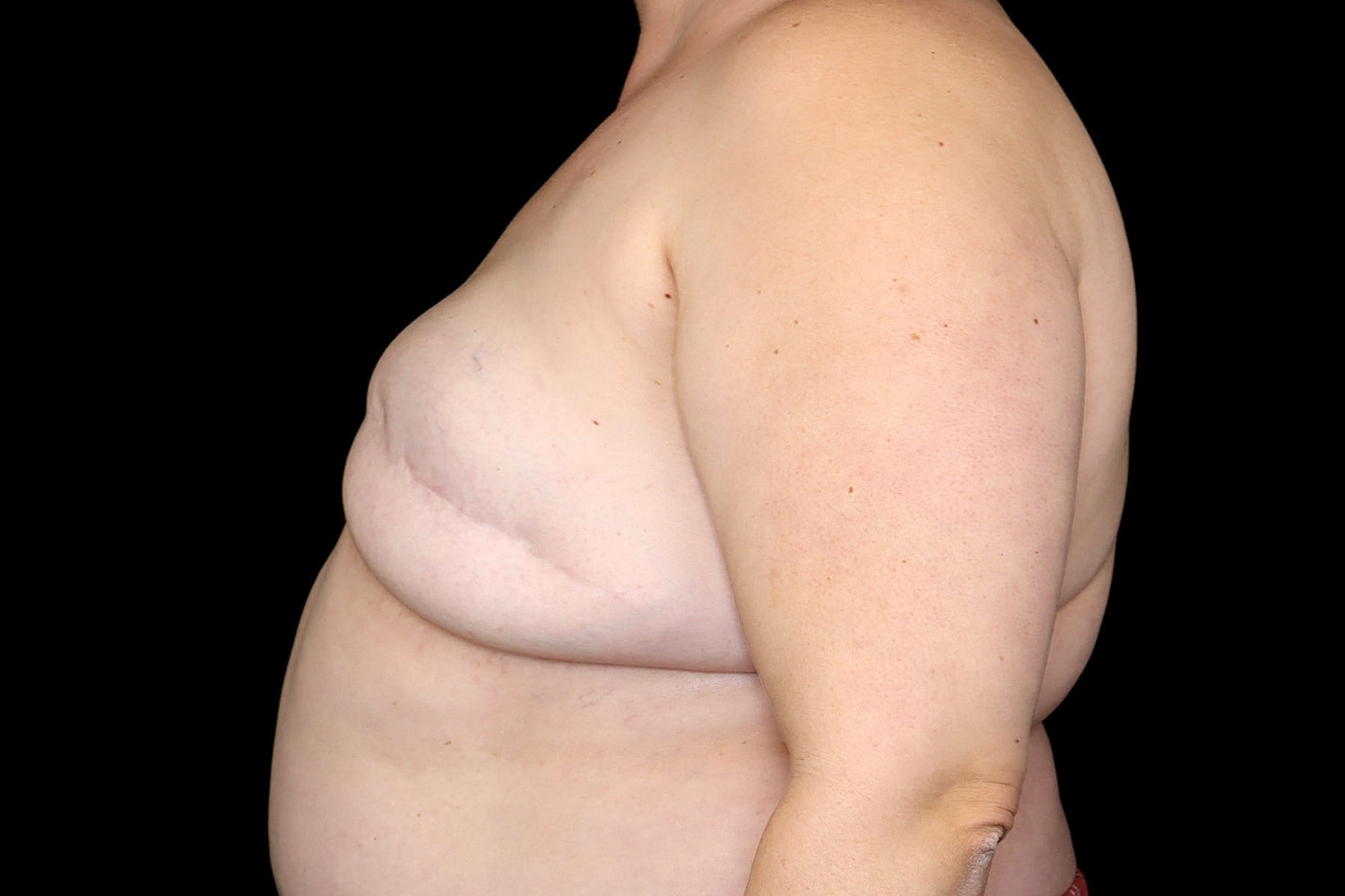Breast Implant Removal Before & After