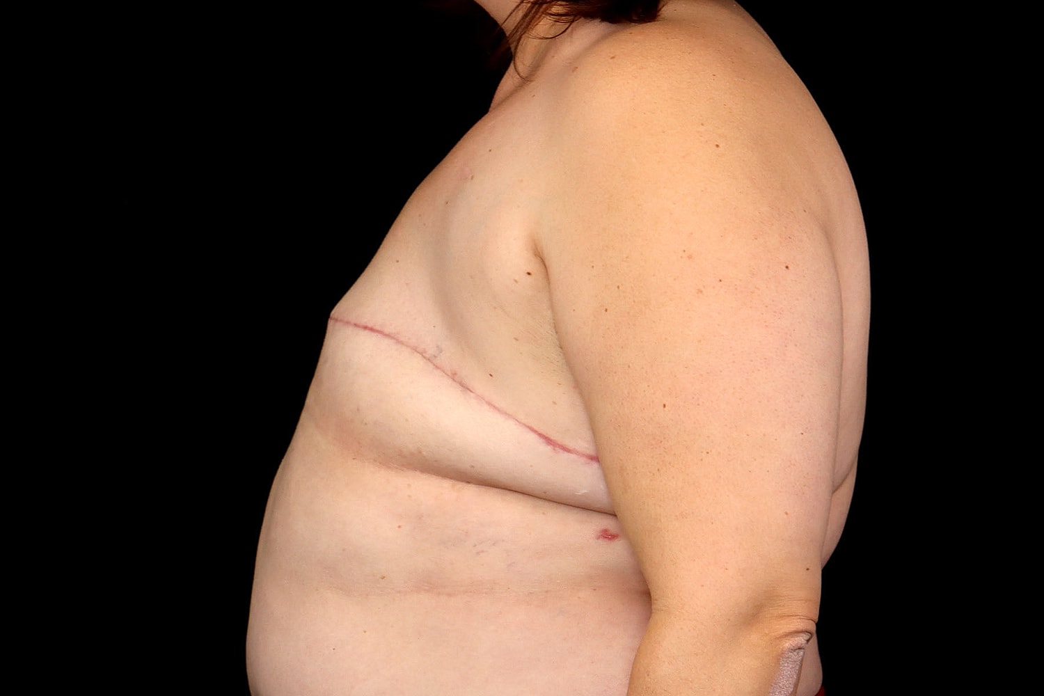 Breast Implant Removal Before & After