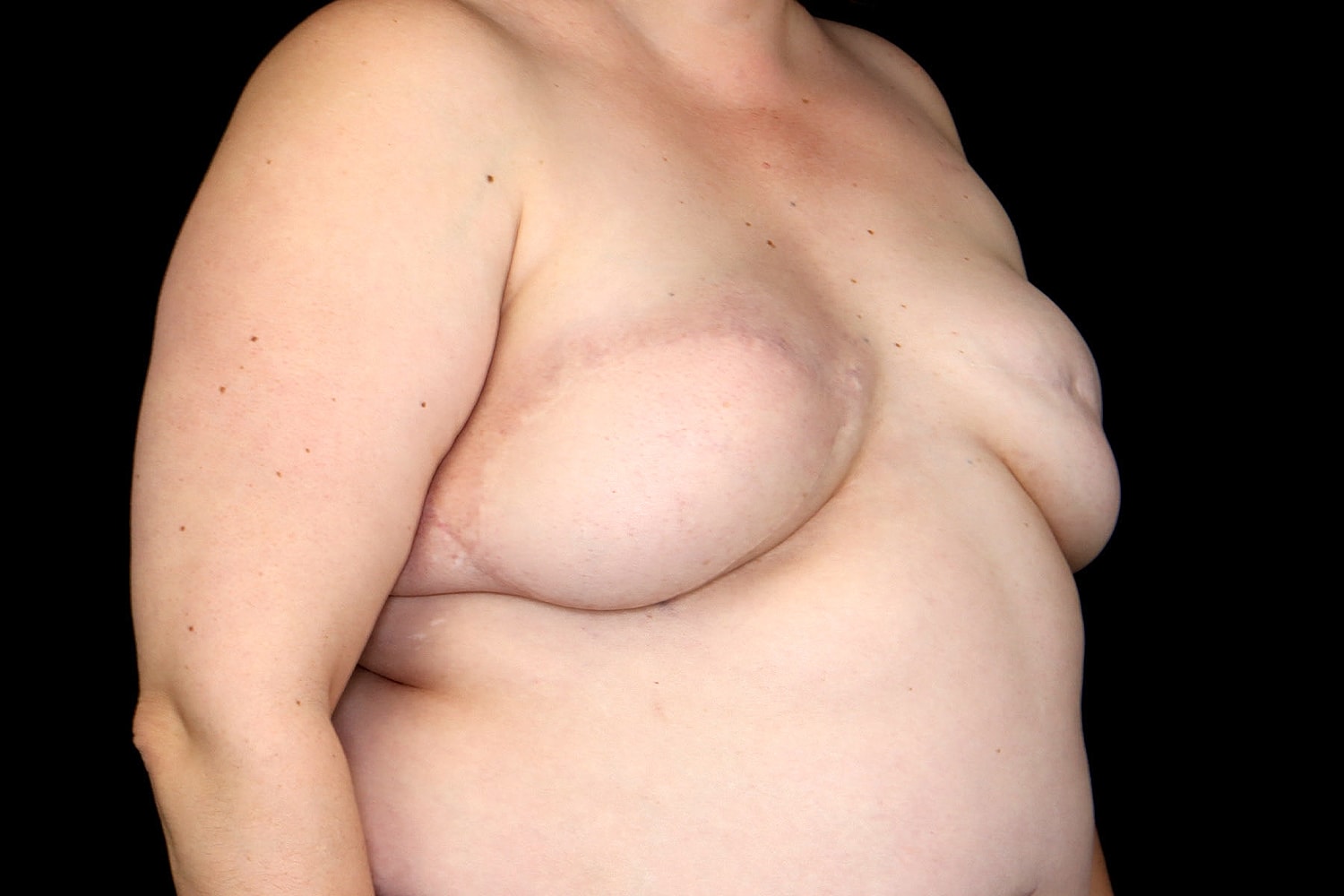Breast Implant Removal Before & After