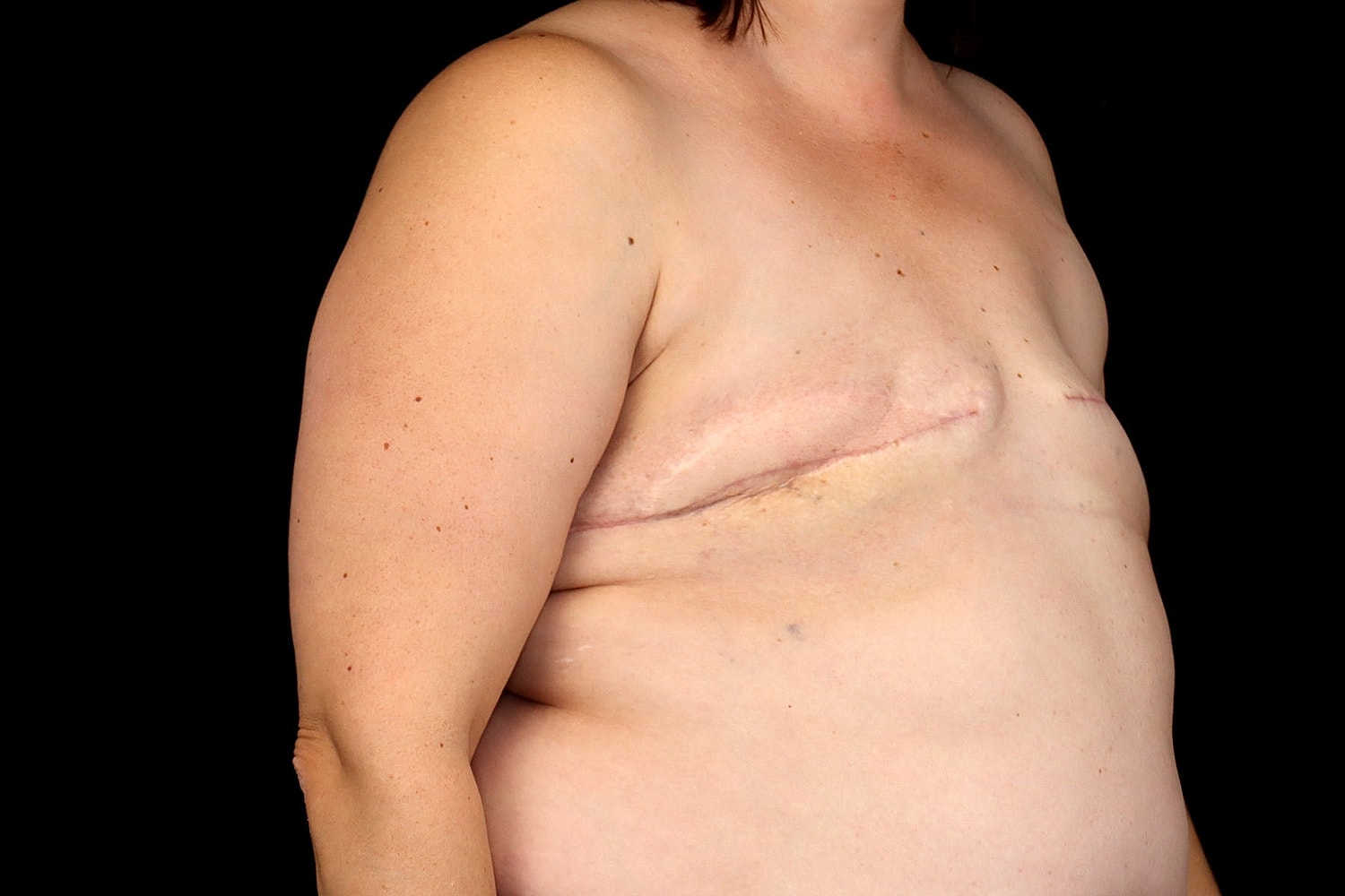 Breast Implant Removal Before & After