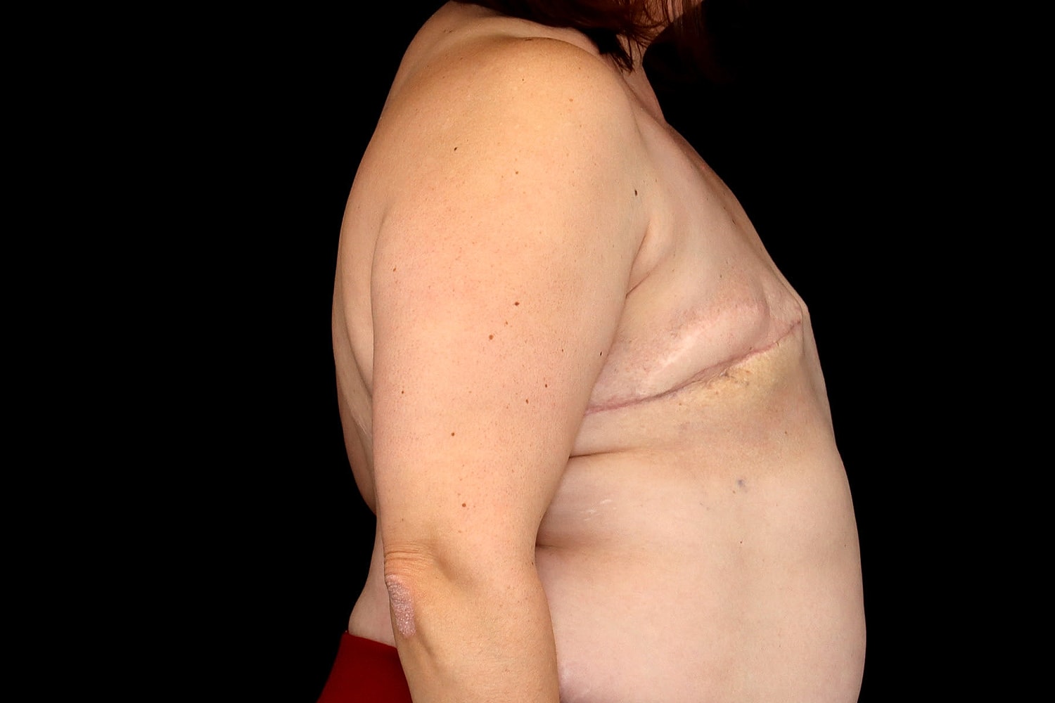 Breast Implant Removal Before & After