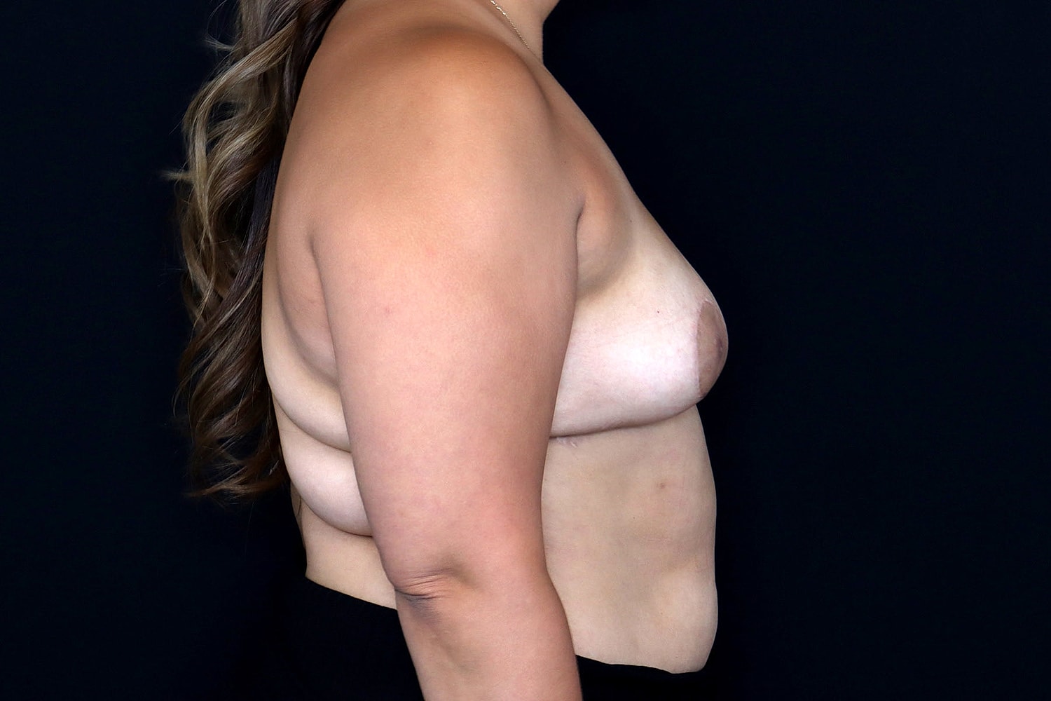 Breast Implant Removal Before & After