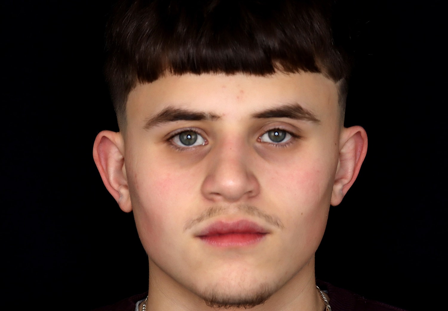Rhinoplasty Before & After