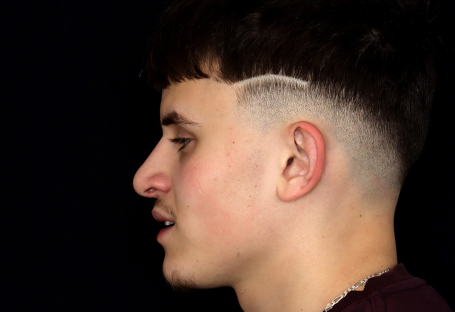 Rhinoplasty Before & After