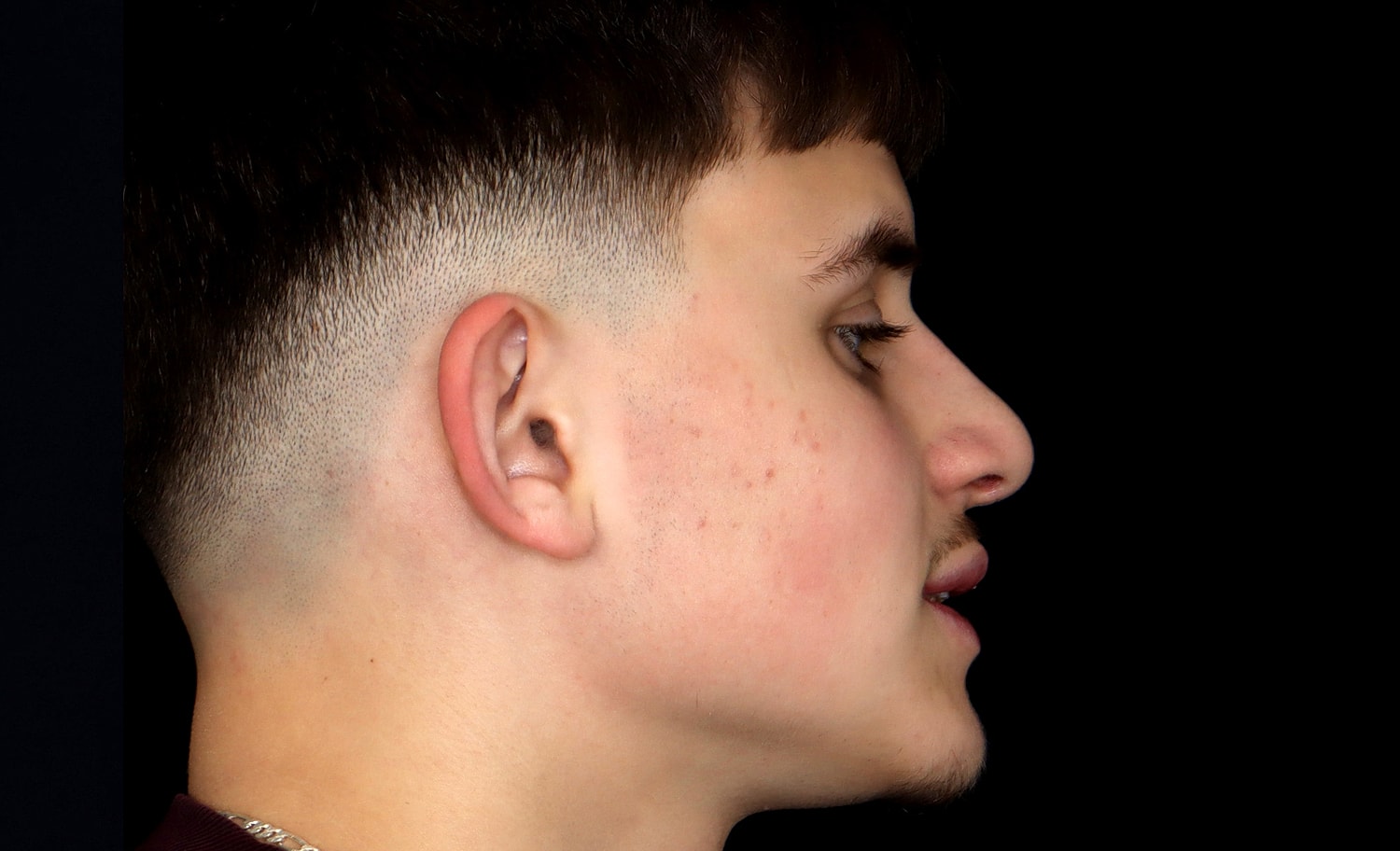 Rhinoplasty Before & After