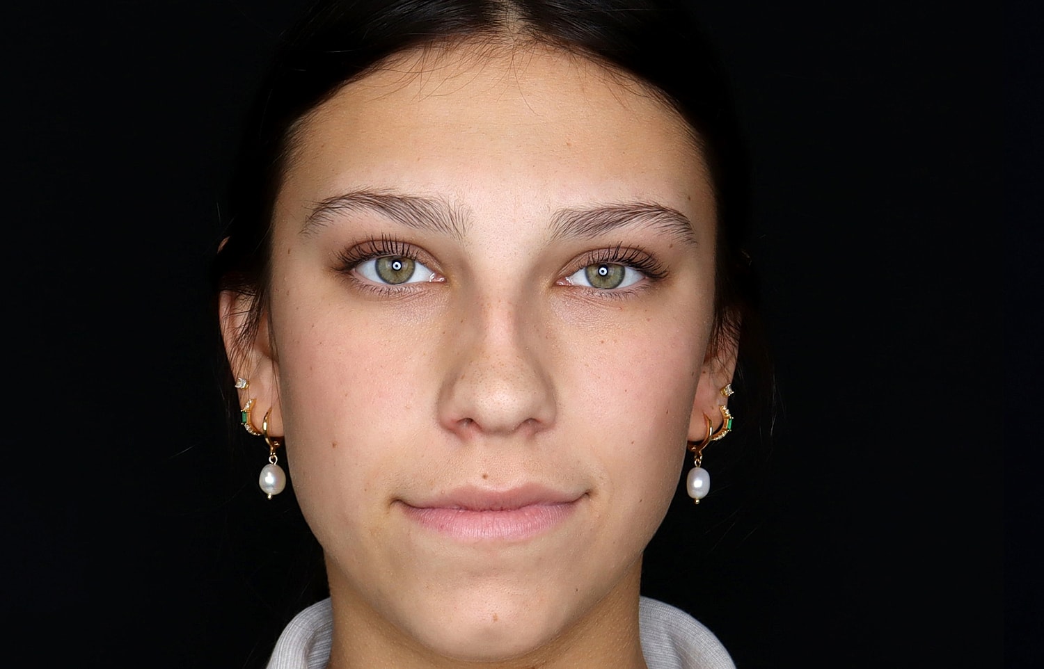 Rhinoplasty Before & After