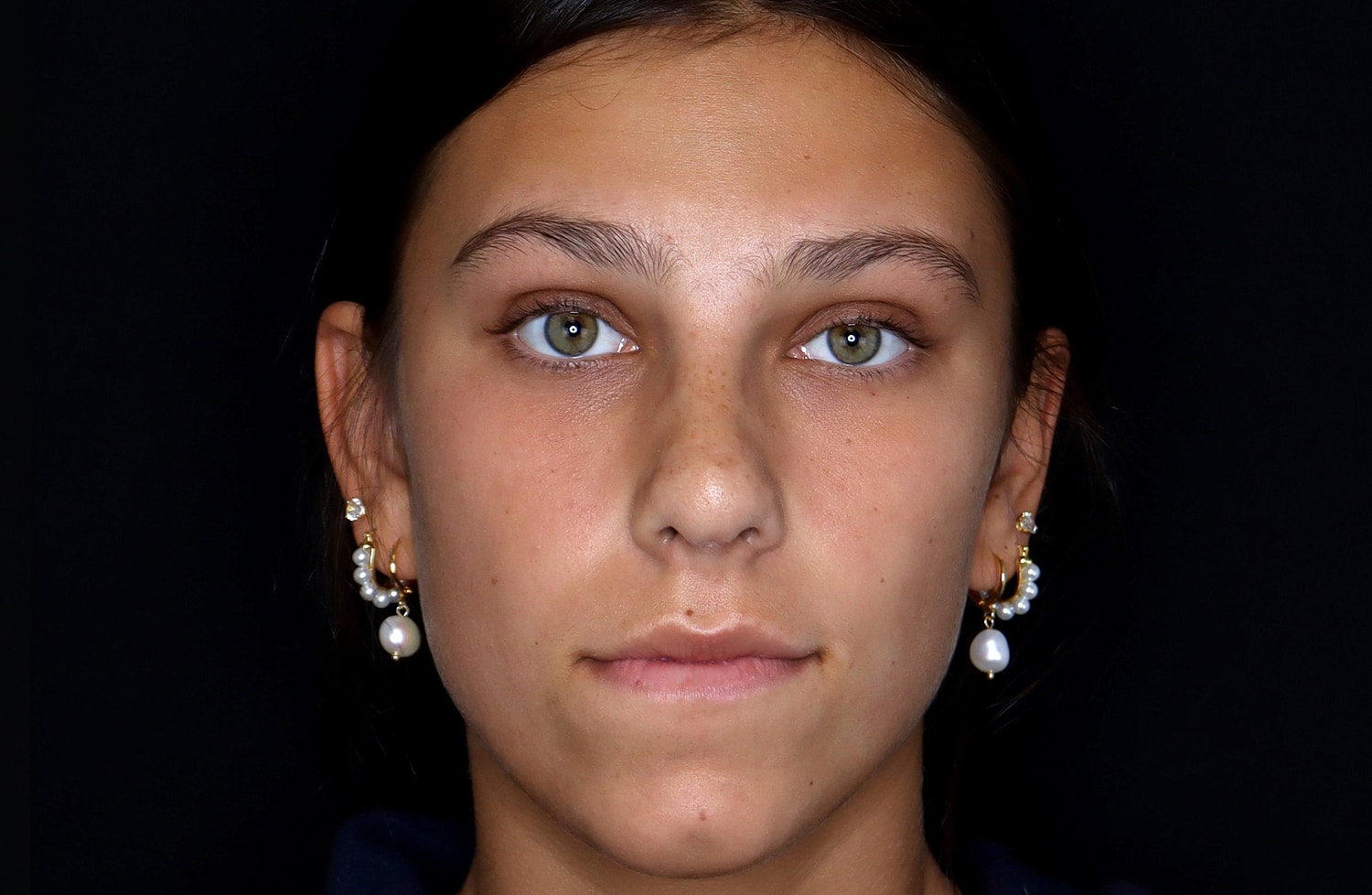 Rhinoplasty Before & After
