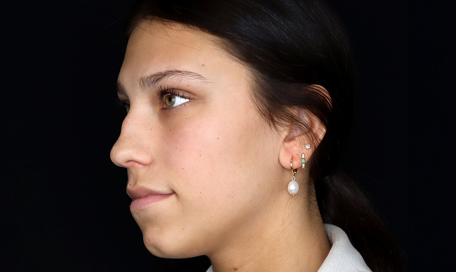 Rhinoplasty Before & After