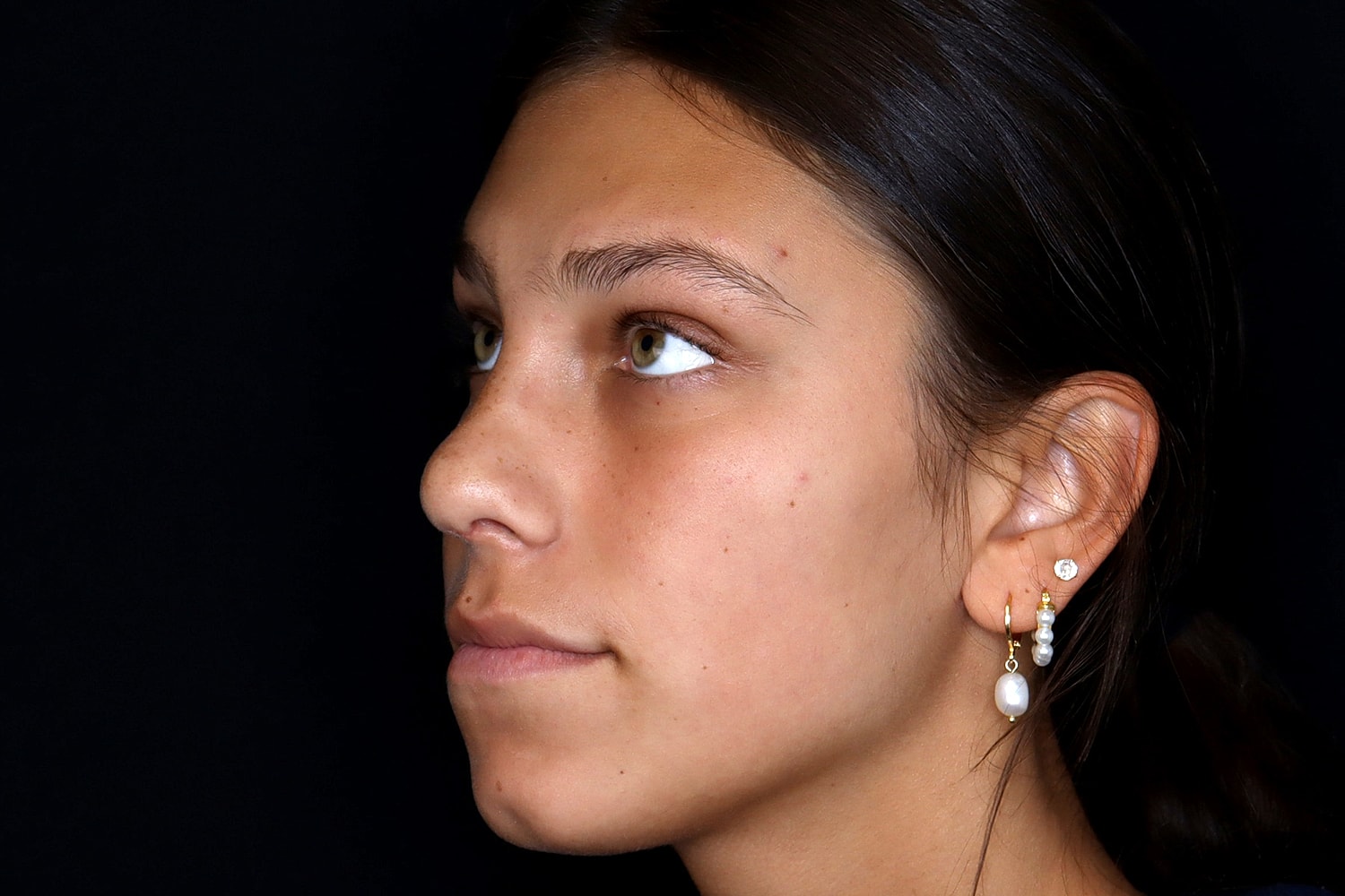 Rhinoplasty Before & After