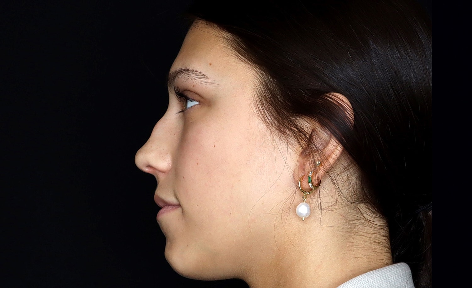 Rhinoplasty Before & After