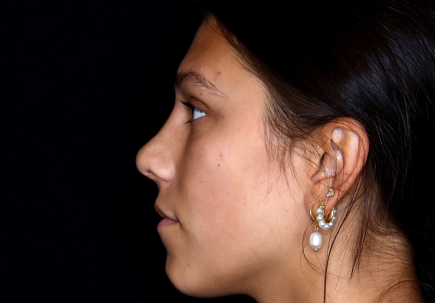 Rhinoplasty Before & After