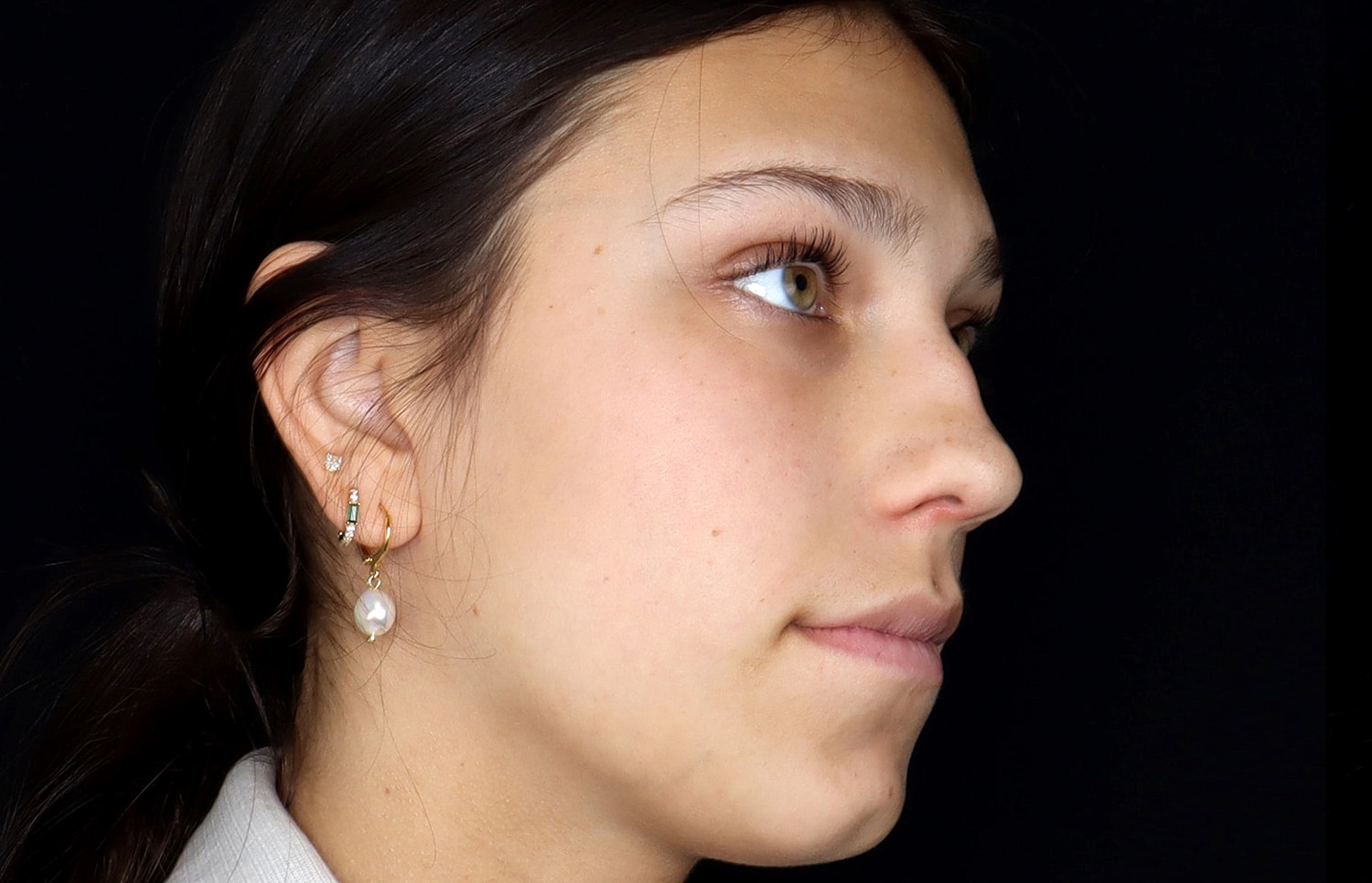 Rhinoplasty Before & After