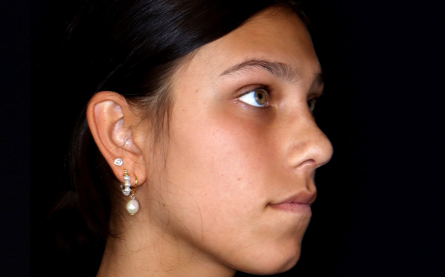 Rhinoplasty Before & After