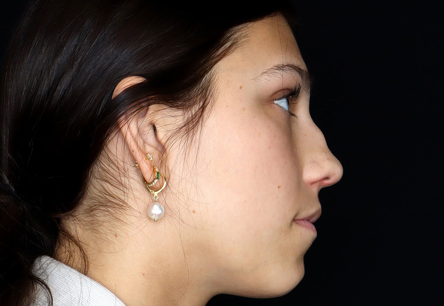 Rhinoplasty Before & After
