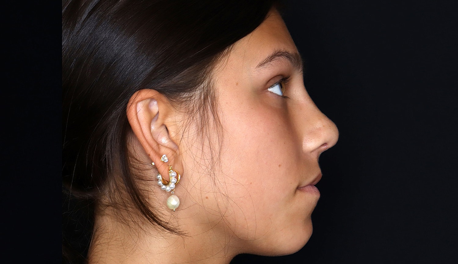 Rhinoplasty Before & After