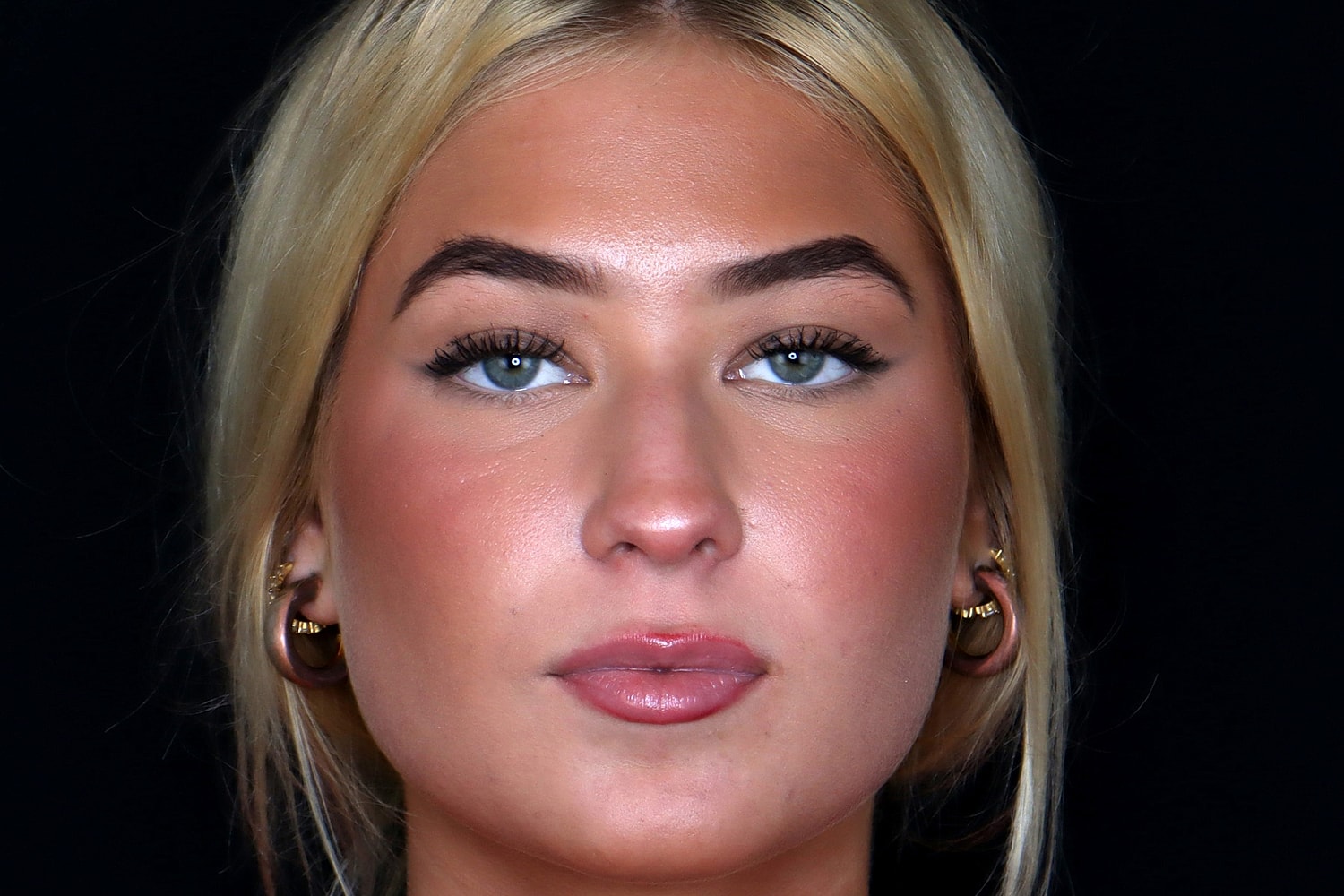 Rhinoplasty Before & After