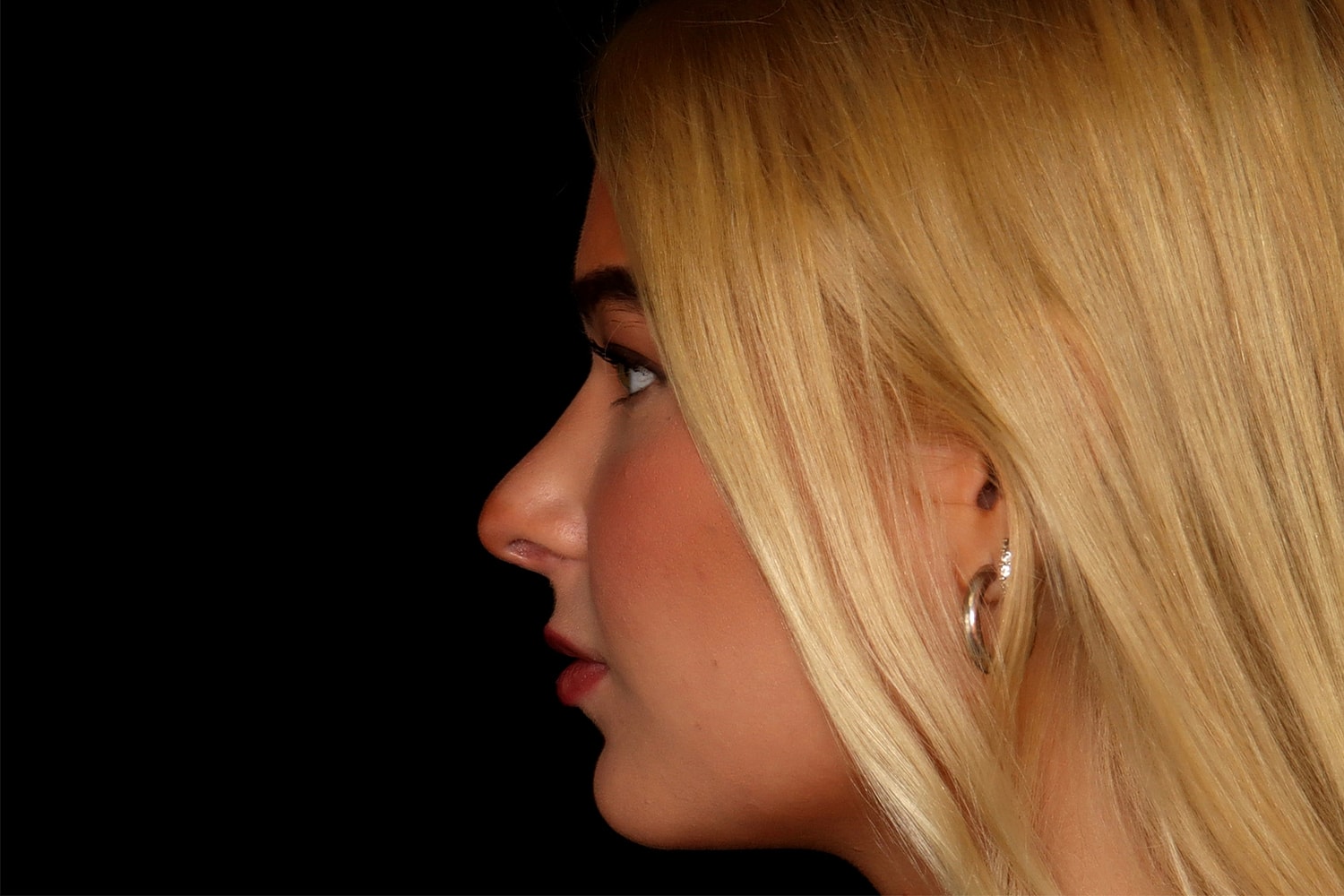 Rhinoplasty Before & After