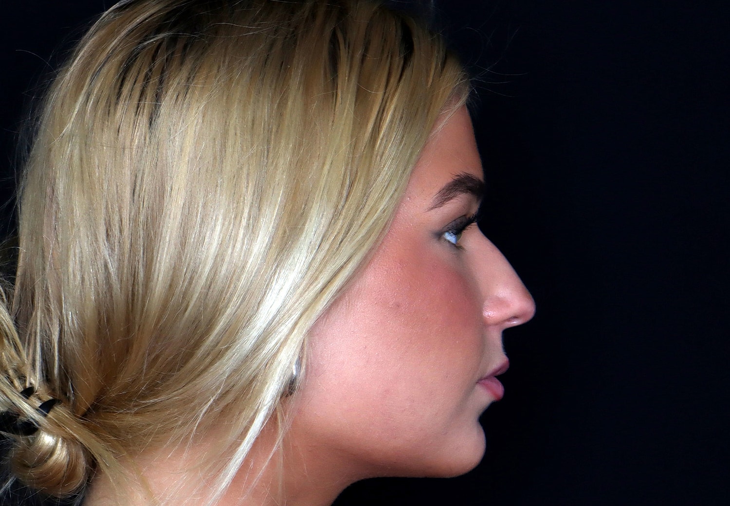Rhinoplasty Before & After