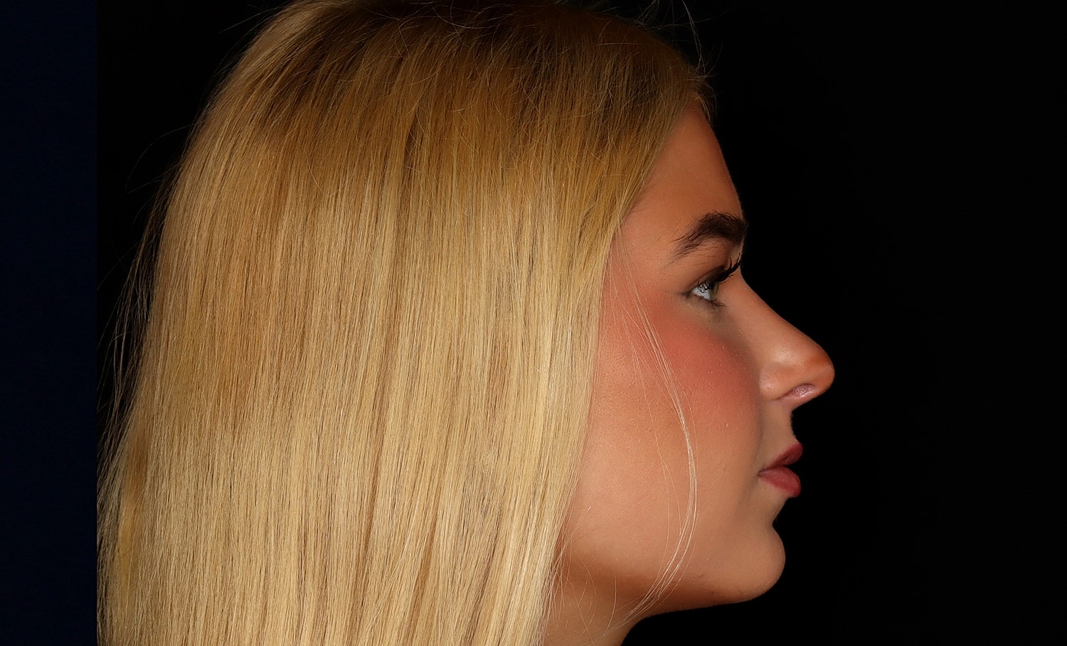Rhinoplasty Before & After