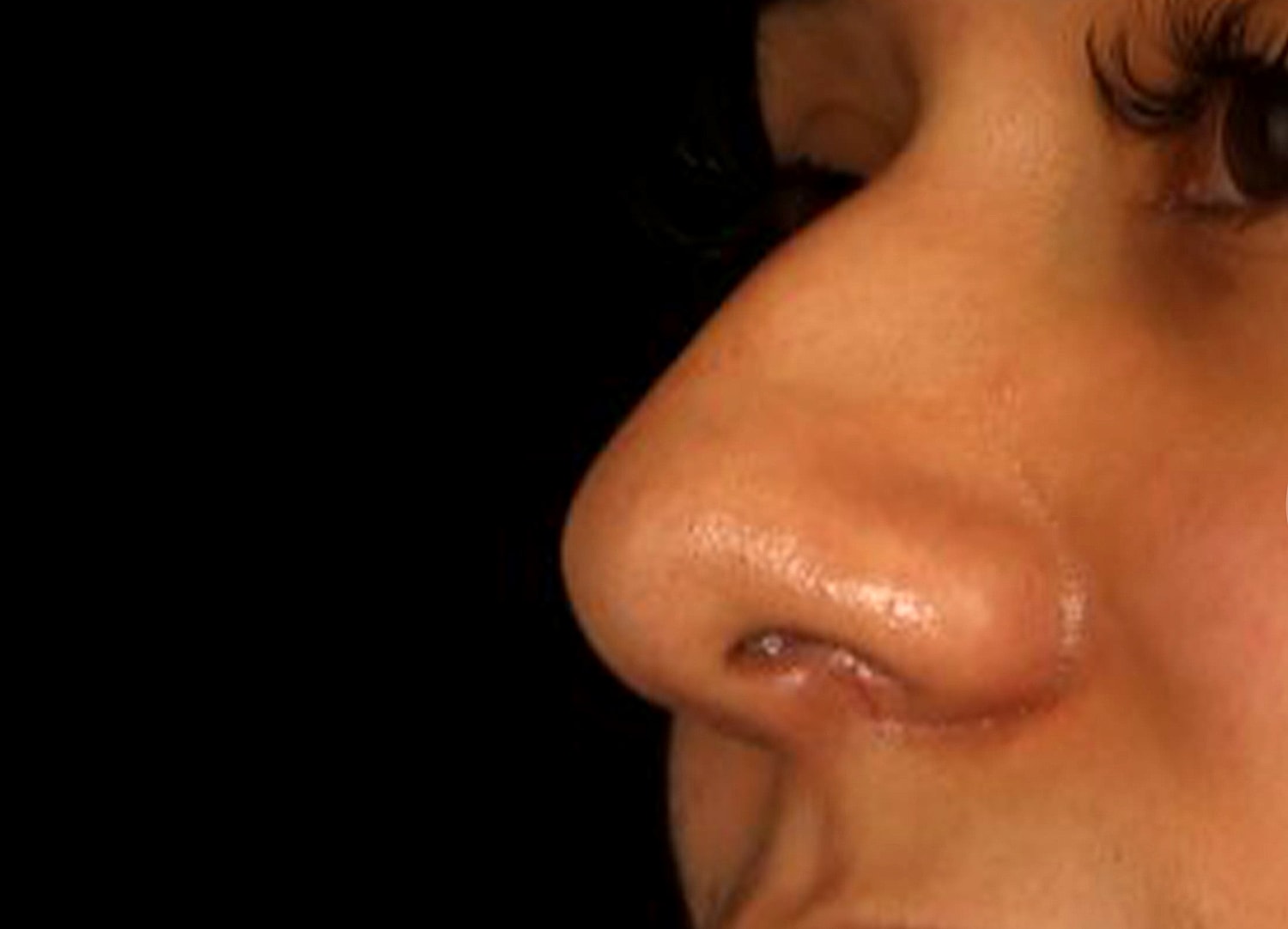 Rhinoplasty Before & After