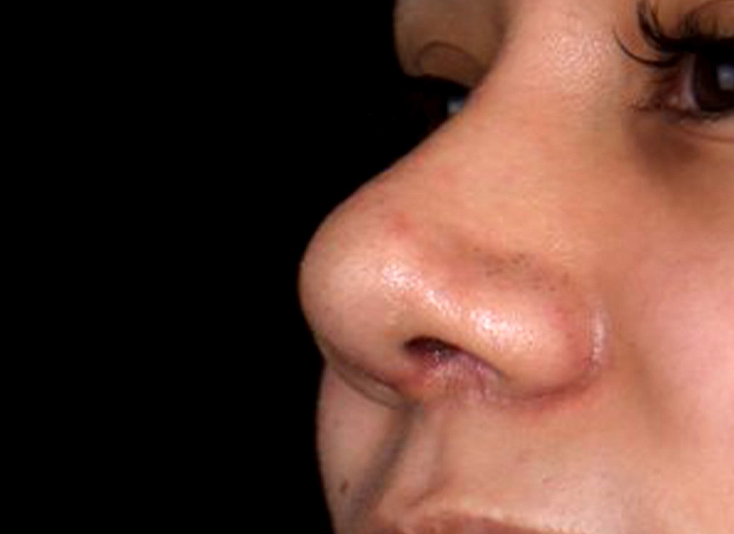 Rhinoplasty Before & After