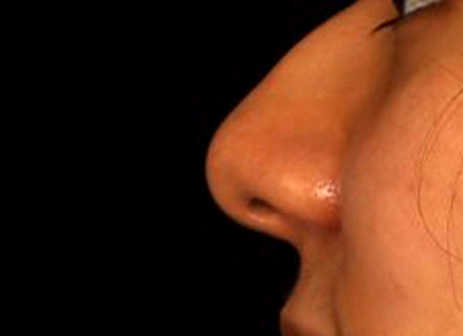 Rhinoplasty Before & After