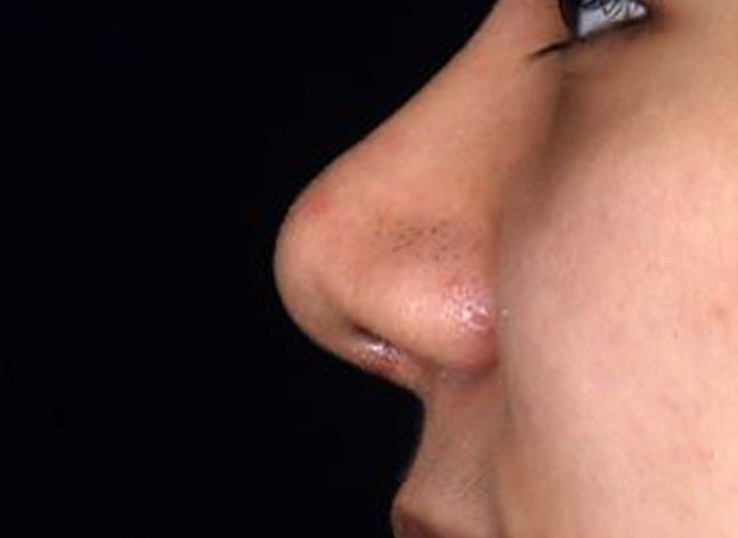 Rhinoplasty Before & After