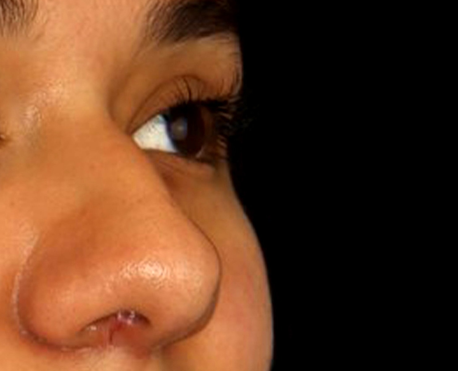 Rhinoplasty Before & After