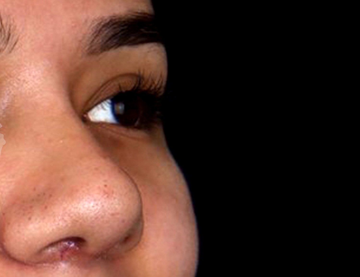 Rhinoplasty Before & After