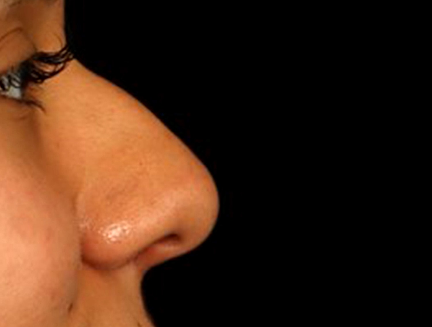 Rhinoplasty Before & After